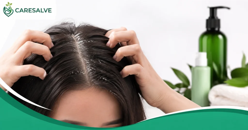 Dandruff Treatment: How to Get Rid of Dandruff and Choose the Best Shampoo
