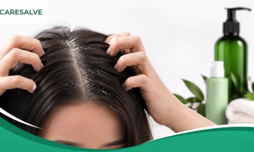 Dandruff Treatment: How to Get Rid of Dandruff and Choose the Best Shampoo