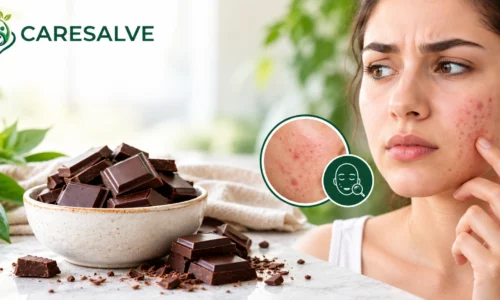 Does Chocolate Cause Acne? What Research Says
